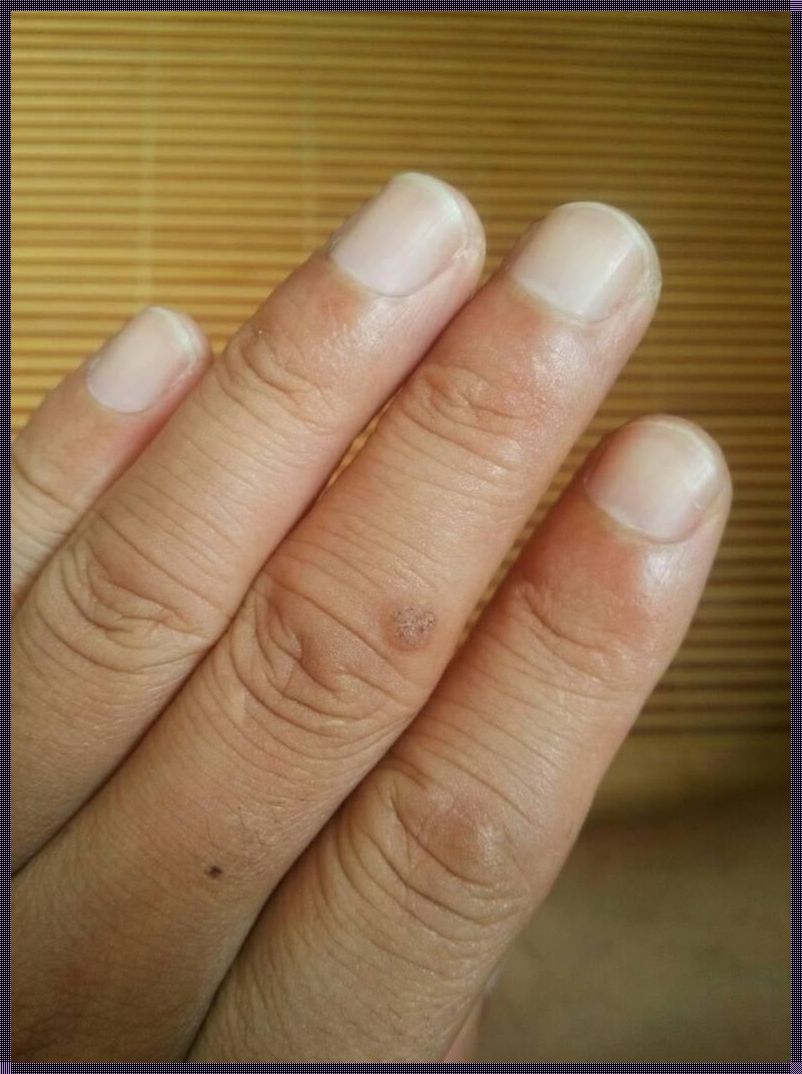 手指疣初期什么样子（尖锐湿疣初期什么症状,怎么判断尖锐湿疣）