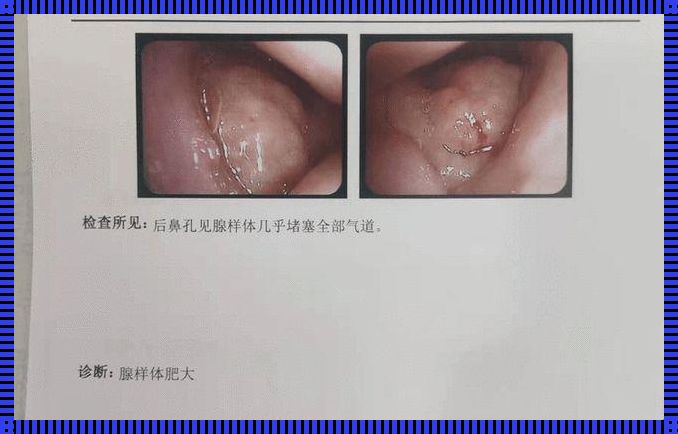 腺样体肥大图片和正常图片比较: 腺样体肥大脸部变化图,怎么治疗,如何预防?