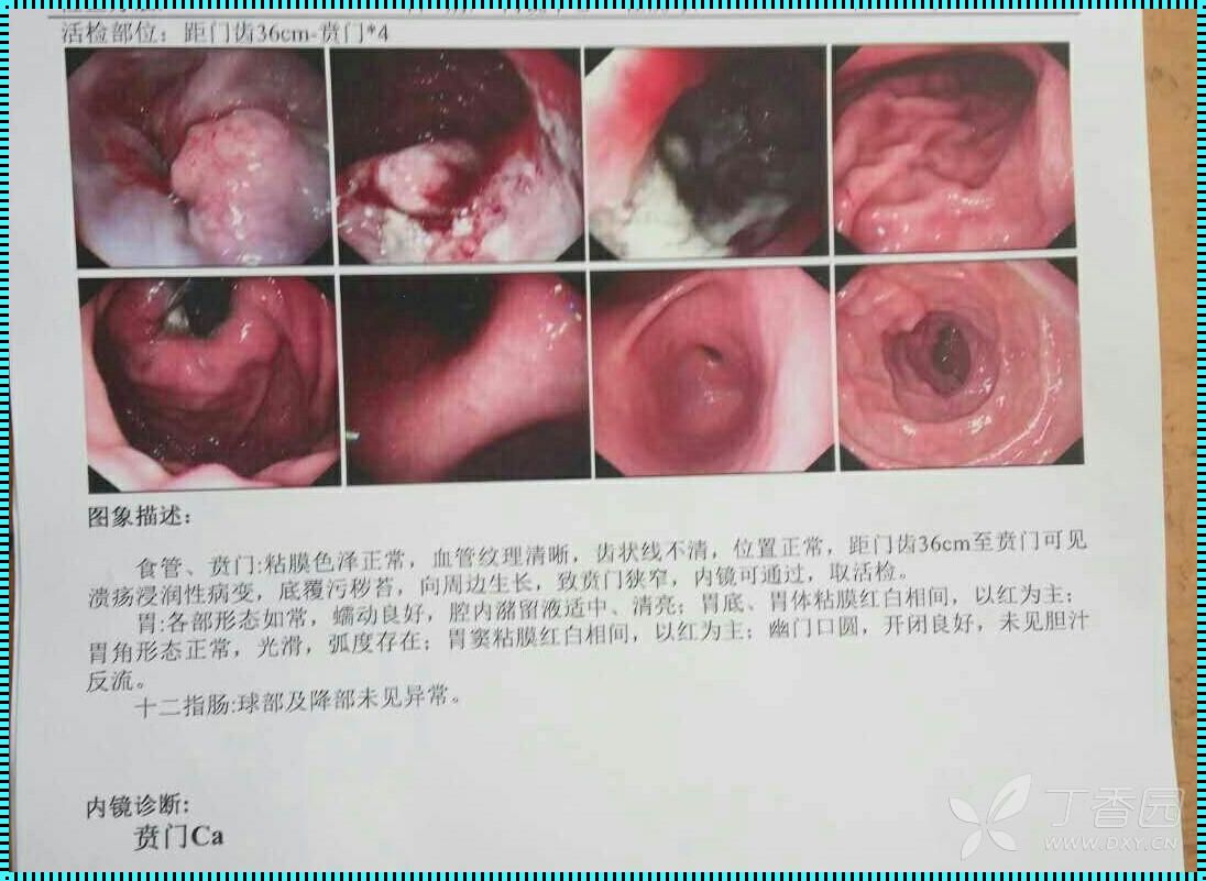 探究贲门癌的形成过程：时间、因素及影响