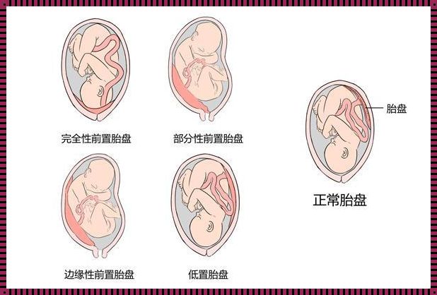 为什么37周胎盘才1级