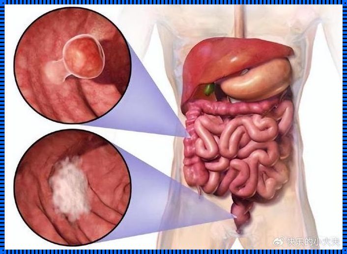 肠癌复发的六大征兆