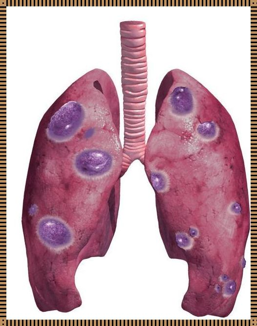 肺结节：探究其传染性之谜