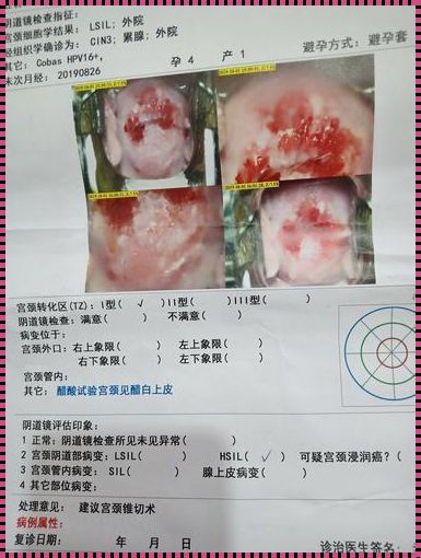 宫颈CIN3：良性还是恶性的神秘面纱