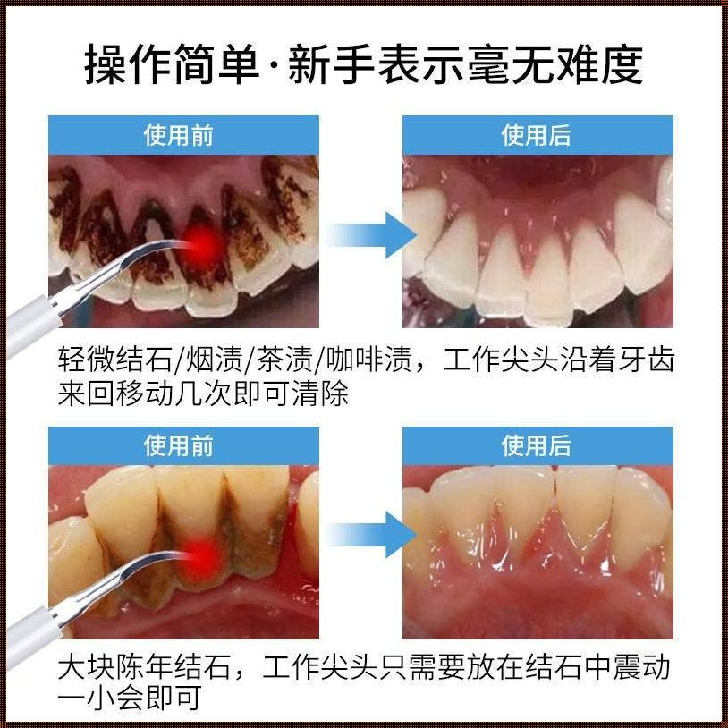 牙缝里的黑垢怎样去除