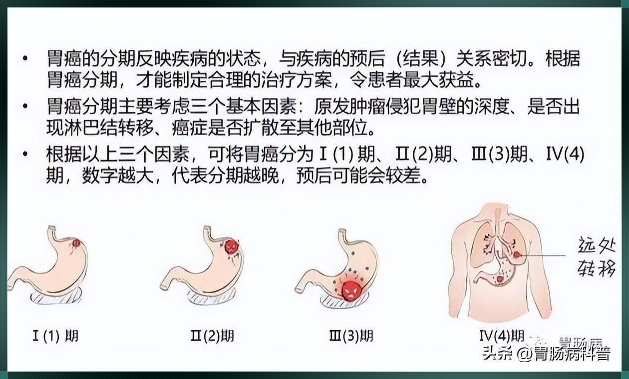 胃癌4期没有扩散能治愈吗？