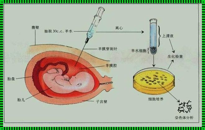 羊水穿刺seq指什么