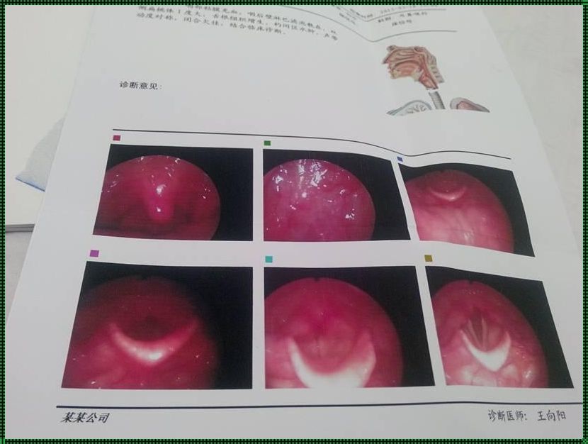 出气喉咙发出蜂鸣声是什么问题