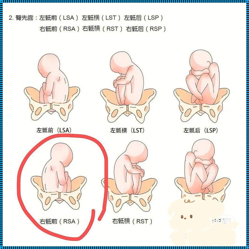 臀位看性别容易出错吗？揭秘