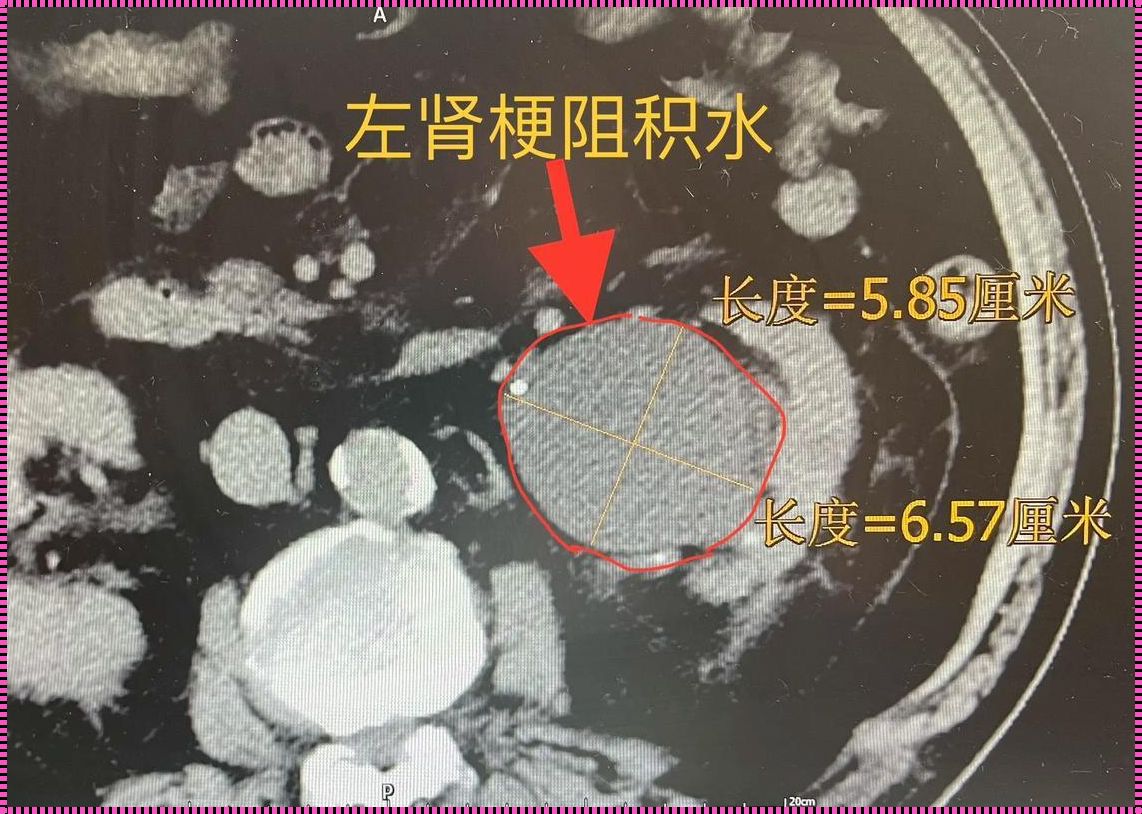 前列腺偏大伴结石：探索治疗之路的深层思考