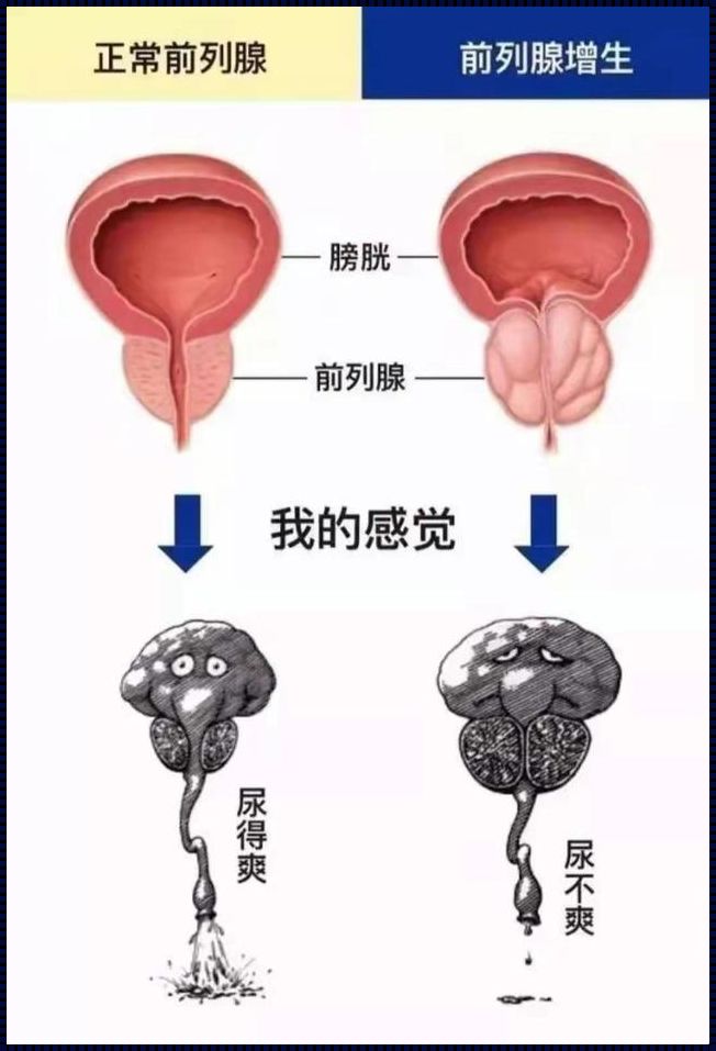 前列腺增大还能恢复正常吗：生命的奇迹与医学的边界