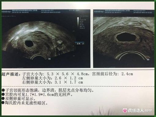 怀孕40天空囊正常吗：生命的奇迹与医学的边界