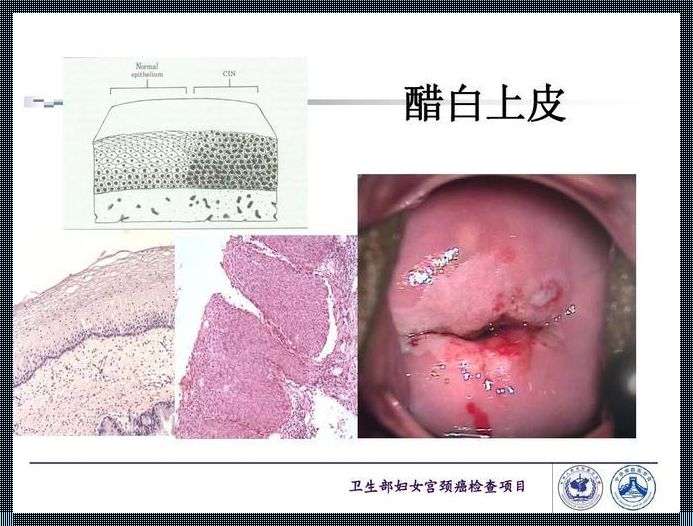 宫颈醋酸白色上皮：生命的警示与希望的启示