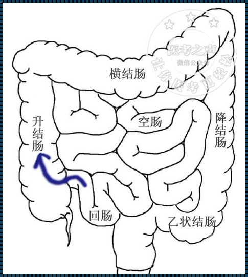 肠结核：治愈之路上我们走到了哪一步