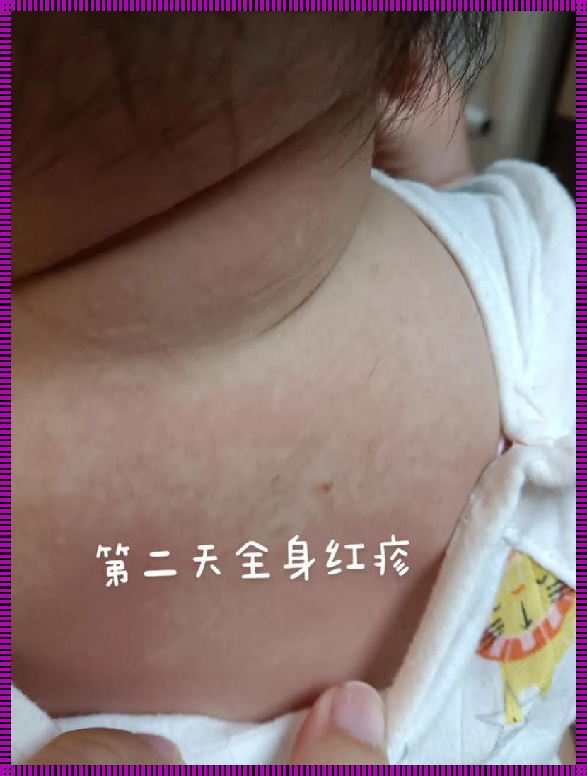 麻腮风出疹与发烧：孕妇的神奇“超能力”之谜