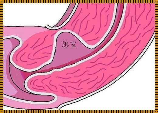 子宫憩室：终身相伴，还是暂时逗留?