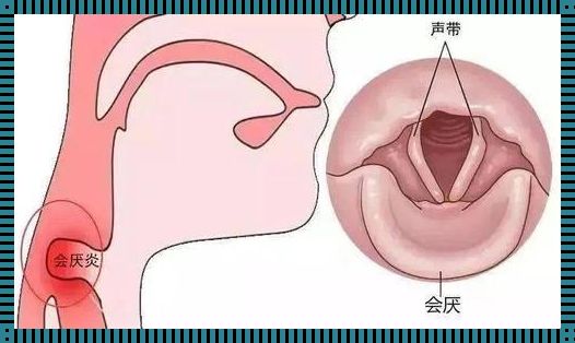 喉咙里的小叛逆：会厌炎，疼痛的秘密基地