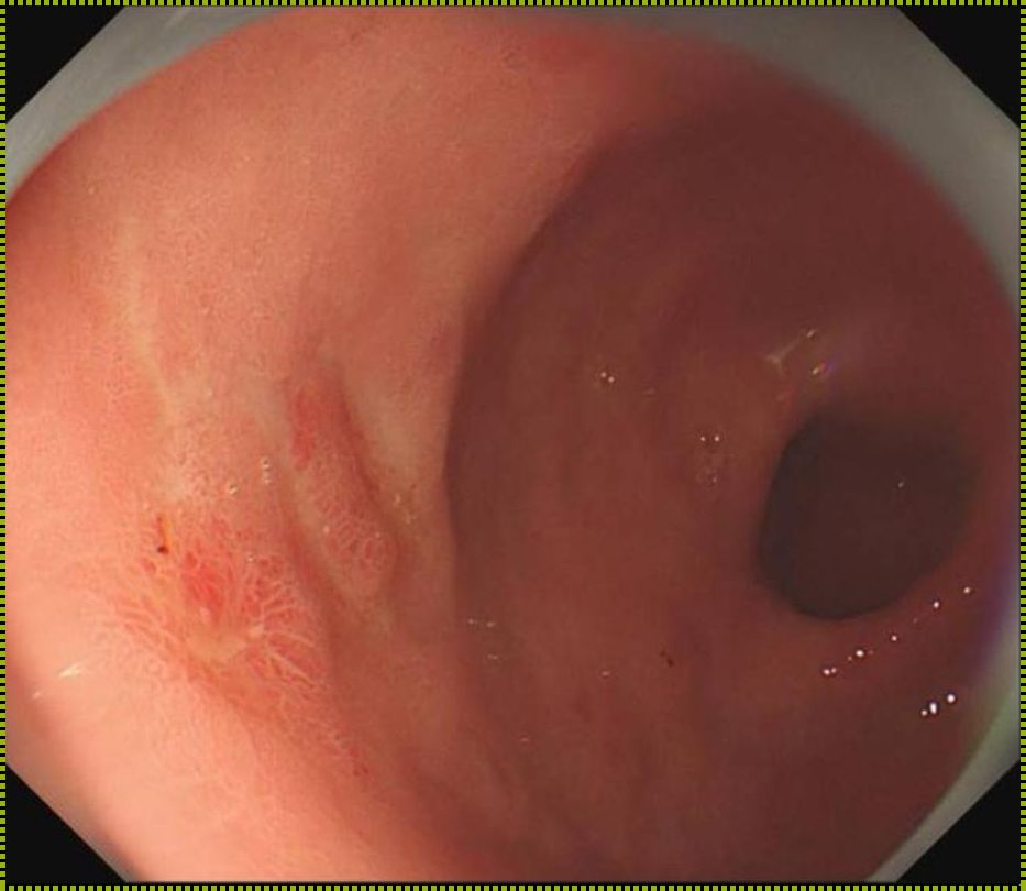 早期胃窦腺癌，治愈之路的“谜团”大揭秘