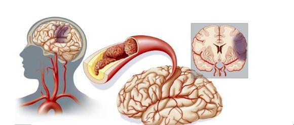 脑梗后，新血管会否不请自来？
