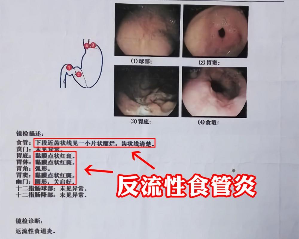 食道炎诊断记：笑谈痛点，揭秘秘辛