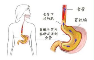 “食道炎”来袭，竟是因为这些“神奇”原因！