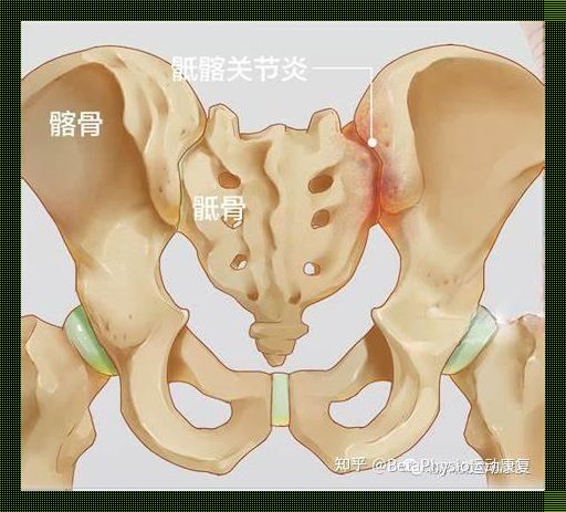 骶骨筋膜炎位置图，揭秘！