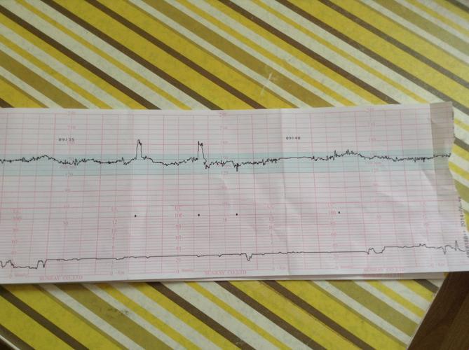 胎心监测，toco数值蹦迪在20至40之间！这可咋整？