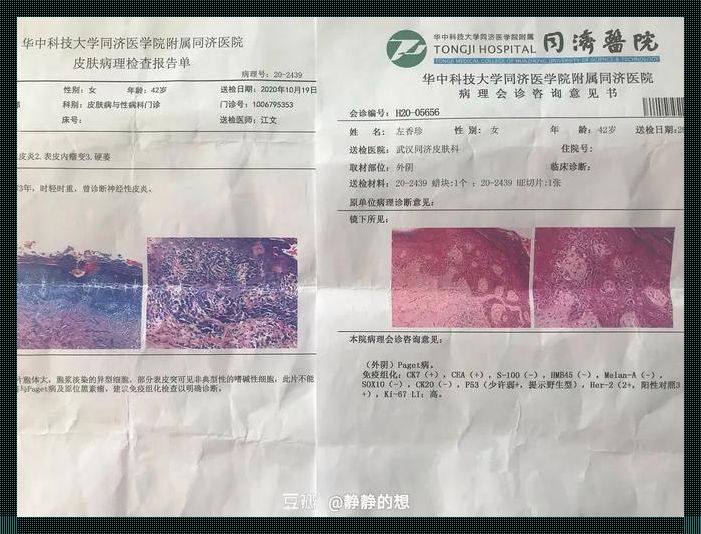 恶性肿瘤活检报告单，笑谈间的诡异艺术